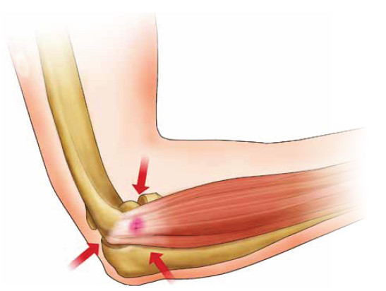 epicondilitis-03